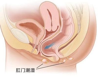 泉州肛门湿疹该怎么治疗?