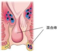 泉州医博混合痔的有效治疗方法是什么