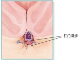 泉州医博怎么治肛门湿疹?