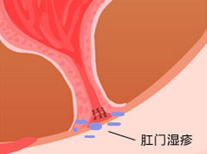 泉州该怎么治肛门湿疹?