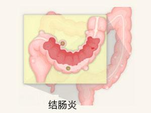 泉州治结肠炎哪个医院好